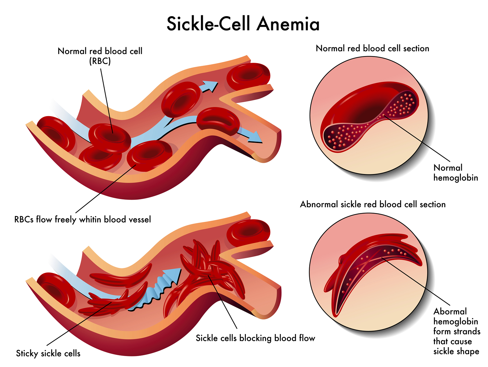 Risk-Factors-for-Sickle-Cell-Anemia (1)2